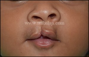 Incomplete cleft lip defect in 3 months old baby girl