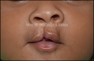 Incomplete cleft lip defect in 3 months old baby girl