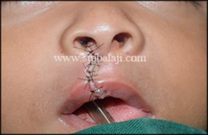 Immediately after suturing