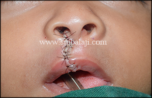 Immediately after suturing