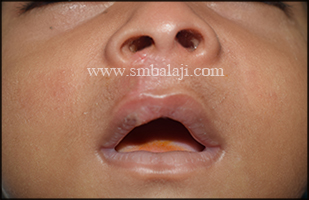 Immediately after suture removal following seven days after surgery