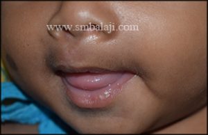 Postoperative view after 2 weeks showing enhanced appearance