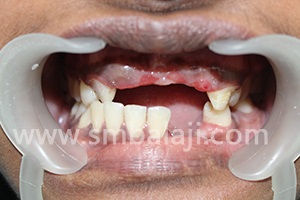 A young girl lost multiple teeth in a vehicular accident