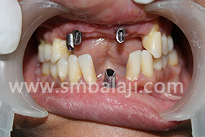 BMP and Dental Implants 7 Abutments placed