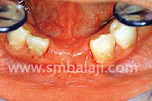 Adequate bone formation following distraction osteogenesis