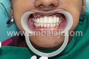 After complete treatment