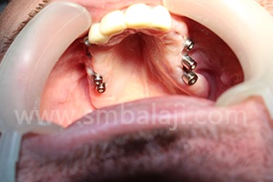 After implant surgery in upper jaw