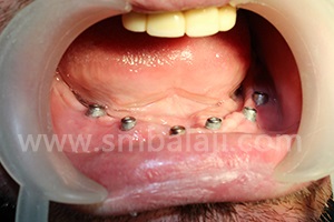 After placement of implants in lower jaw