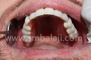 After prosthesis placed in upper jaw