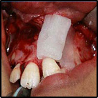 Bone Morphogenetic Protein 2 rhBMP-2 placed in bony defect avoiding bone graft
