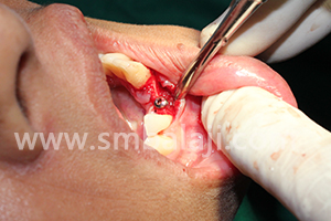 BMP and Dental Implants 6 BMP inserted adjacent to the implant