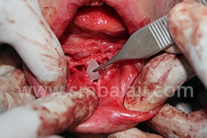 BMP placed to stimulate new bone formation in lower jaw