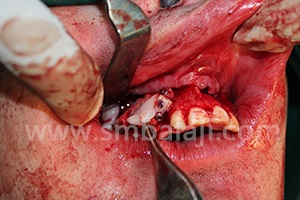 BMP placed to stimulate new bone formation