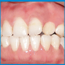 Bone Morphogenetic Protein 3 Complete cleft closure after rhBMP-2 surgery and orthodontic teeth alignment