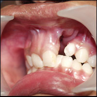 Bone Morphogenetic Protein 1 Cleft defect in alveolar bone