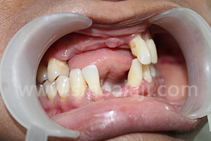 BMP and Dental Implants 1 Before surgery multiple missing teeth