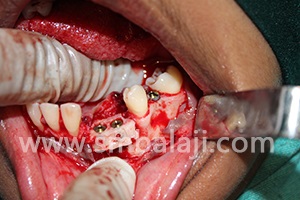 Bone graft and implants placed in lower jaw