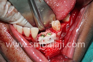 Bone graft placed in deficient region in lower jaw