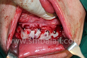 Bone reinforced with rhBMP-2 and graft and implants placed in lower jaw