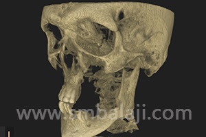 CBCT scan image showing very thin bone in both jaws