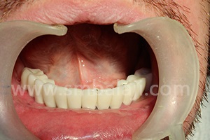 Ceramic prosthesis placed resembling natural teeth
