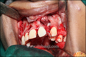 Bone Morphogenetic Protein 6 During procedure cleft alveolus was surgically exposed
