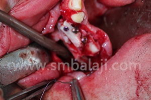 Graft with implants placed in the right upper jaw