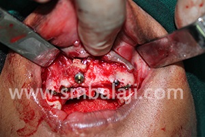 Harvested graft used to strengthen bone in the upper jaw