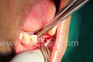 BMP and Dental Implants 3 Implant placed