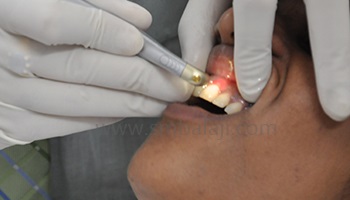 Laser Dentistry | Pain-free Treatment