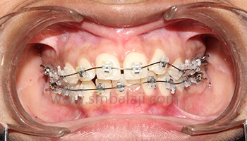 Malaligned Teeth Management | Orthodontics