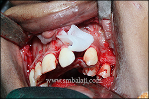Bone Morphogenetic Protein 7 Miracle protein rhBMP-2 placed in the cleft alveolus defect for the cleft closure