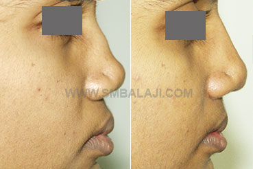 Nasal bridge augmentation surgery on a nose that has a depressed bridge.
