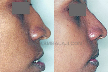 Nasal correction surgery of a nose that was leading to social anxiety...