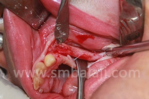 Part of the graft placed in bone deficient region of left upper jaw
