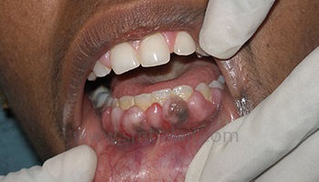Periodontics/Management of Gum diseases
