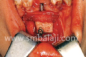 Placement of alveolar distraction device