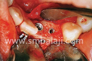 Placement of implant screws