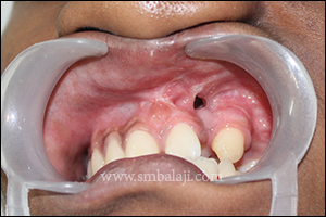 Bone Morphogenetic Protein 5 Preoperative view showing cleft alveolus in the unilateral cleft defect in left side