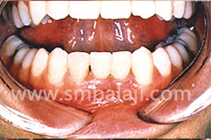Replacement with ceramic crowns