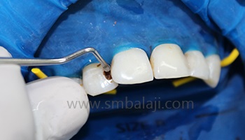 Restorative dentistry / Management of decayed teeth