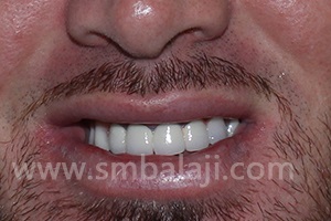 The patient after completion of implant and prosthesis treatment