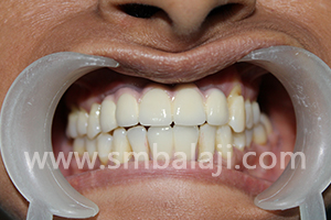 BMP and Dental Implants 8 prosthetic rehabilitation completed with ceramic crowns
