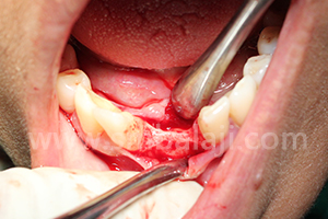 BMP and Dental Implants 2 Very thin bone in lower jaw