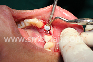 BMP and Dental Implants 5 rhBMP-2 placed to stimulate new bone formation