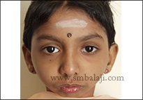 Retruded chin and poor lower jaw growth due to TMJ ankylosis