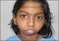 TMJ ankylosis causing stunted growth of lower jaw