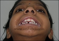 Preoperative view showing decreased mouth opening