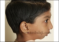 Profile view showing lower jaw defect