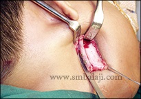 Gap arthroplasty surgery with costochongral graft